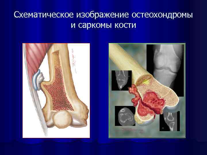 Схематическое изображение остеохондромы и саркомы кости 
