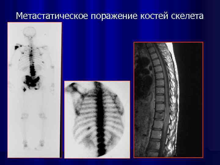 Сцинтиграфическая картина метастатического поражения костей скелета