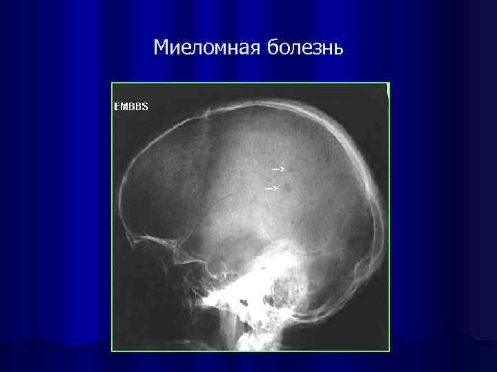 Миеломная болезнь 