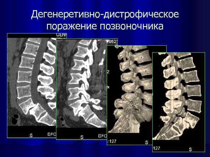 Дегенеретивно-дистрофическое поражение позвоночника 