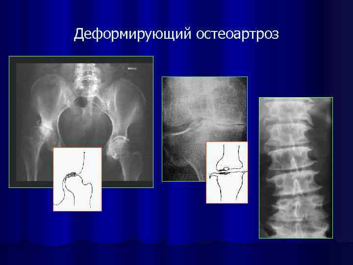 Деформирующий остеоартроз 