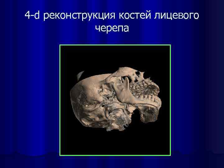 4 -d реконструкция костей лицевого черепа 
