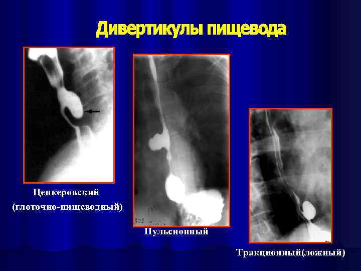 Ценкеровский (глоточно-пищеводный) Пульсионный Тракционный(ложный) 