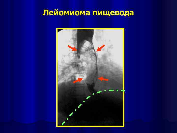 Лейомиома пищевода 
