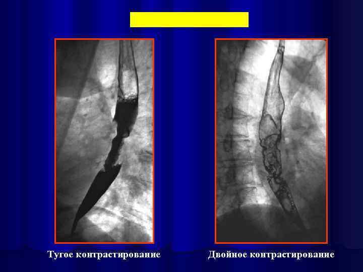 Тугое контрастирование Двойное контрастирование 