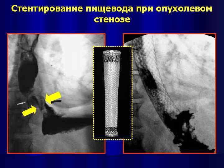 Стентирование пищевода при опухолевом стенозе 