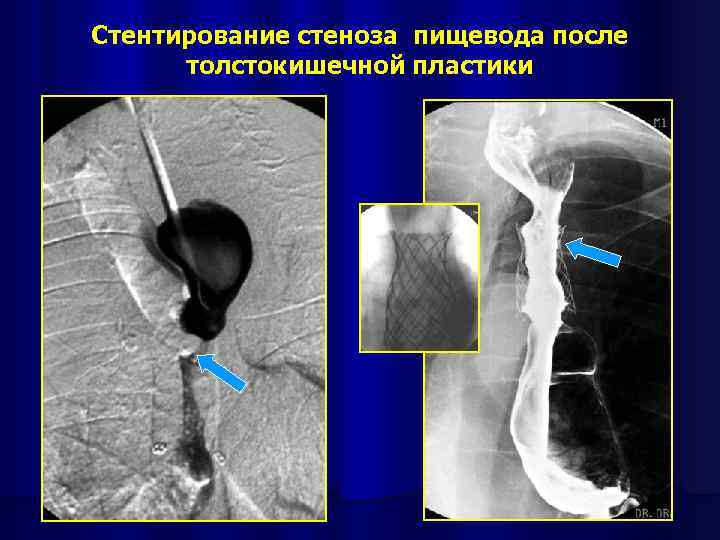 Стентирование стеноза пищевода после толстокишечной пластики 