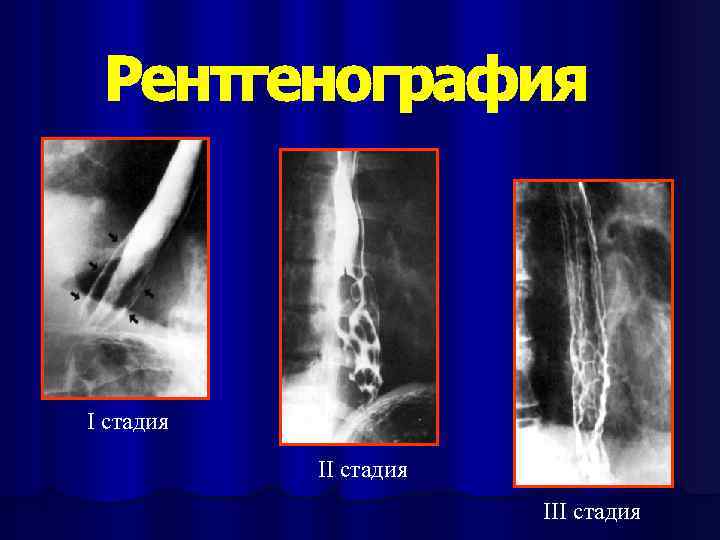 I стадия III стадия 