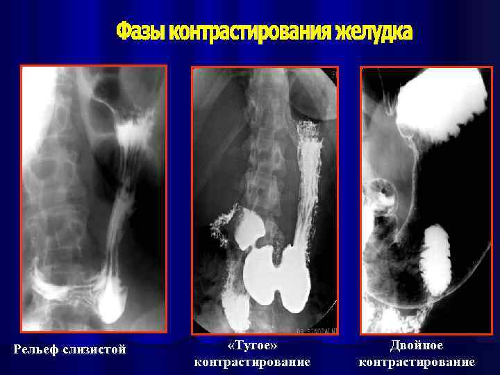 Рельеф слизистой «Тугое» контрастирование Двойное контрастирование 