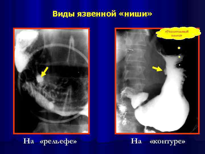 Виды язвенной «ниши» «Указательный палец» На «рельефе» На «контуре» 