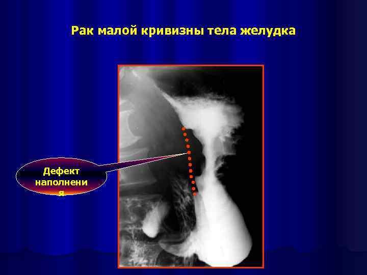 Рак малой кривизны тела желудка Дефект наполнени я 