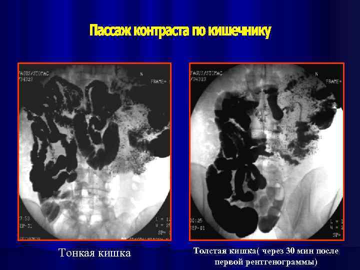 Тонкая кишка Толстая кишка( через 30 мин после первой рентгенограммы) 