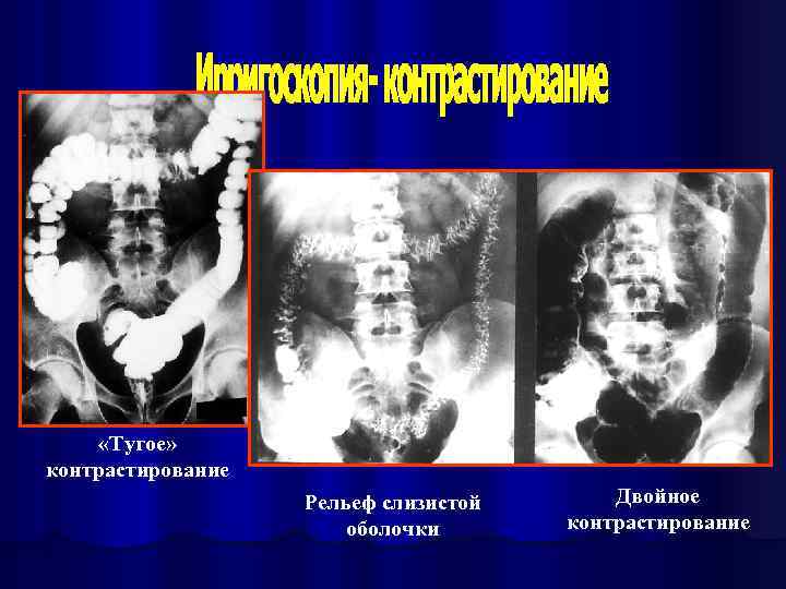  «Тугое» контрастирование Рельеф слизистой оболочки Двойное контрастирование 