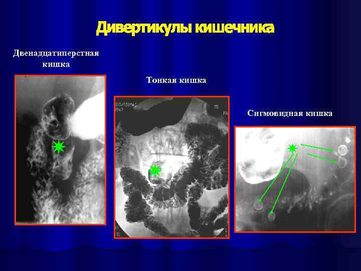 Двенадцатиперстная кишка Тонкая кишка Сигмовидная кишка 