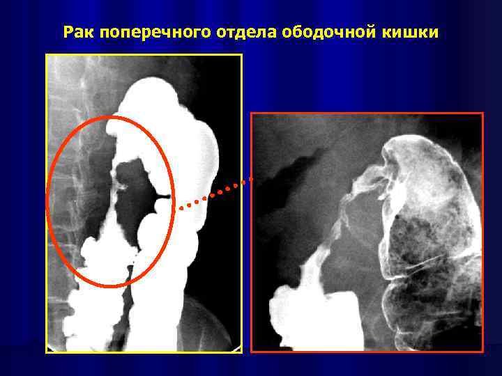 Рак поперечного отдела ободочной кишки 