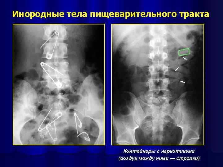 Инородные тела пищеварительного тракта Контейнеры с наркотиками (воздух между ними ― стрелки) 