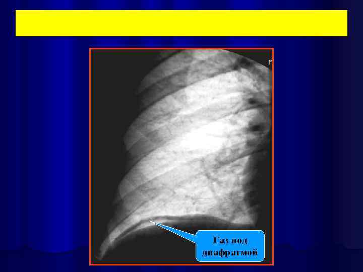Газ под диафрагмой 
