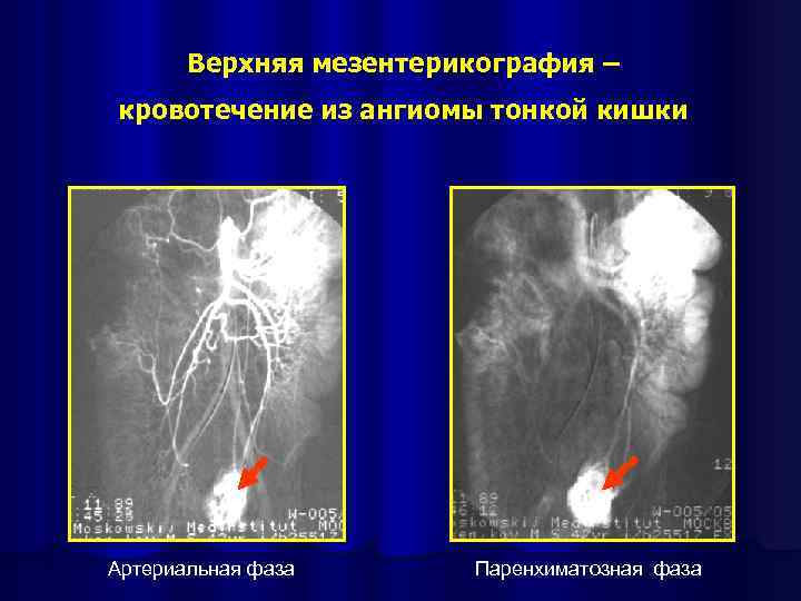 Верхняя мезентерикография – кровотечение из ангиомы тонкой кишки Артериальная фаза Паренхиматозная фаза 