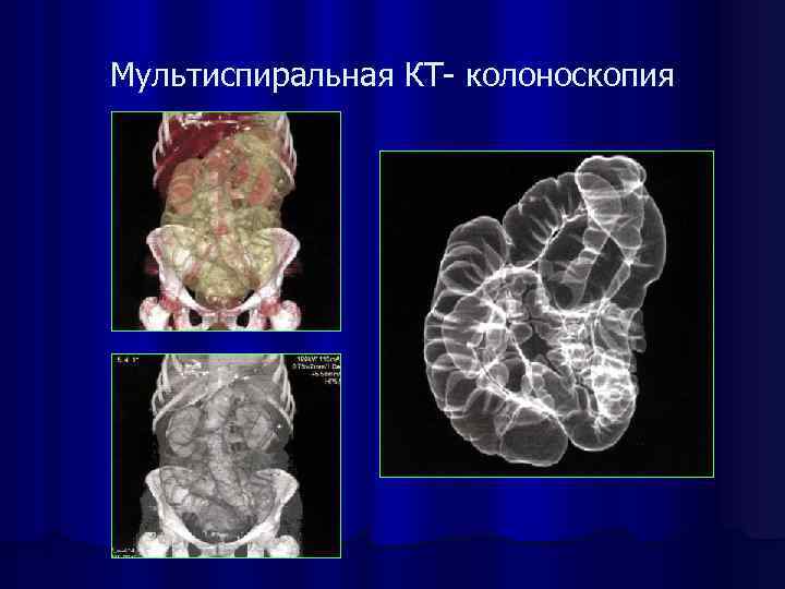 Мультиспиральная КТ- колоноскопия 