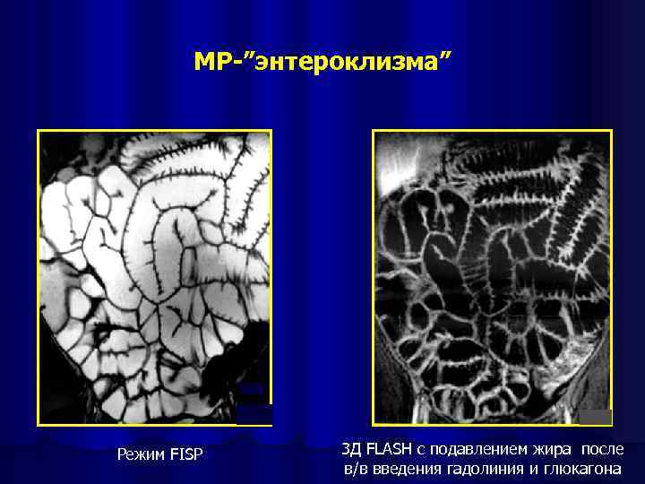 МР-”энтероклизма” Режим FISP 3 Д FLASH c подавлением жира после в/в введения гадолиния и