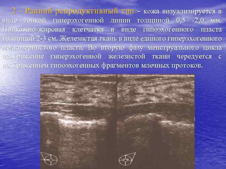 2 - Ранний репродуктивный тип - кожа визуализируется в виде тонкой гиперэхогенной линии толщиной