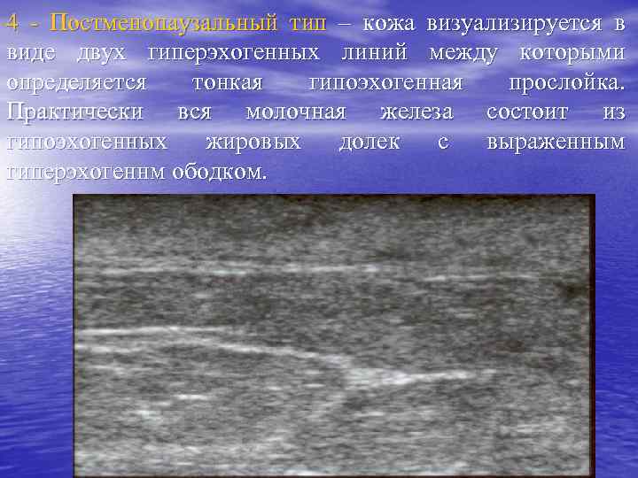 4 - Постменопаузальный тип – кожа визуализируется в виде двух гиперэхогенных линий между которыми