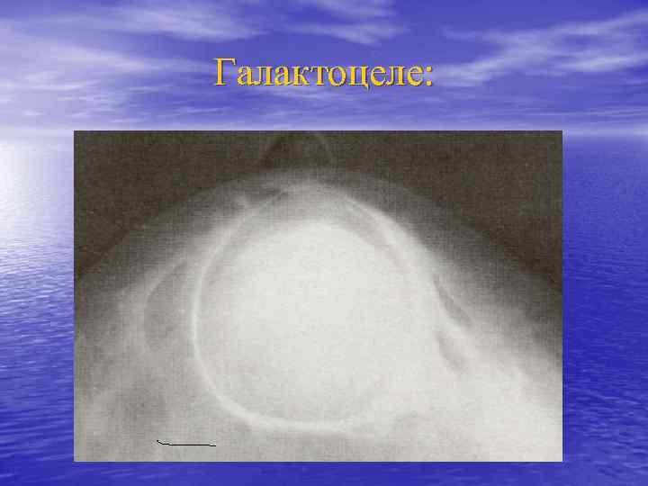 Галактоцеле: 