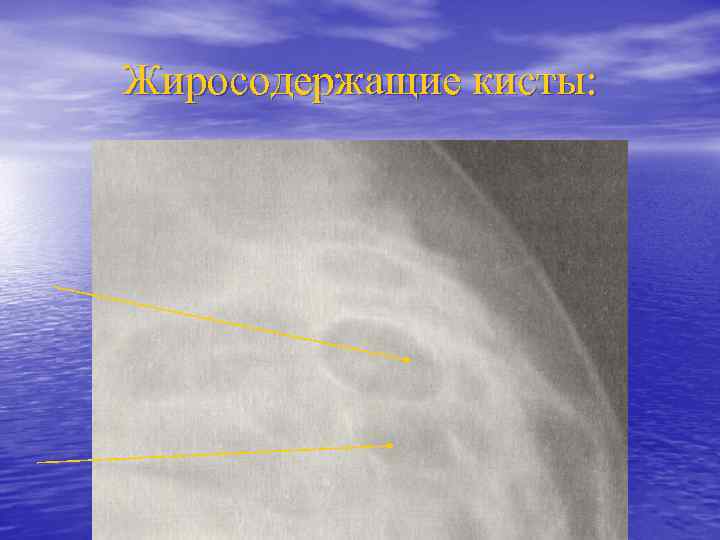 Жиросодержащие кисты: 