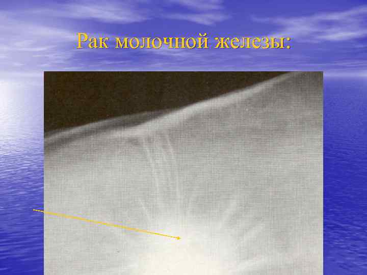 Рак молочной железы: 