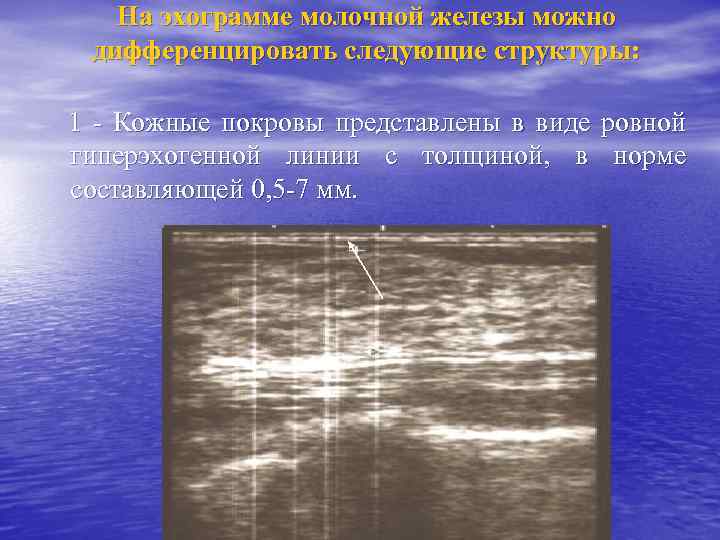 На эхограмме молочной железы можно дифференцировать следующие структуры: 1 - Кожные покровы представлены в