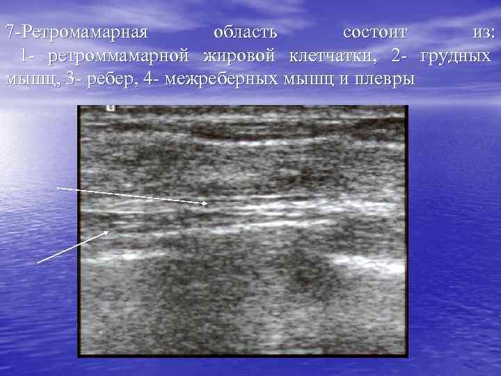 7 -Ретромамарная область состоит из: 1 - ретроммамарной жировой клетчатки, 2 - грудных мышц,
