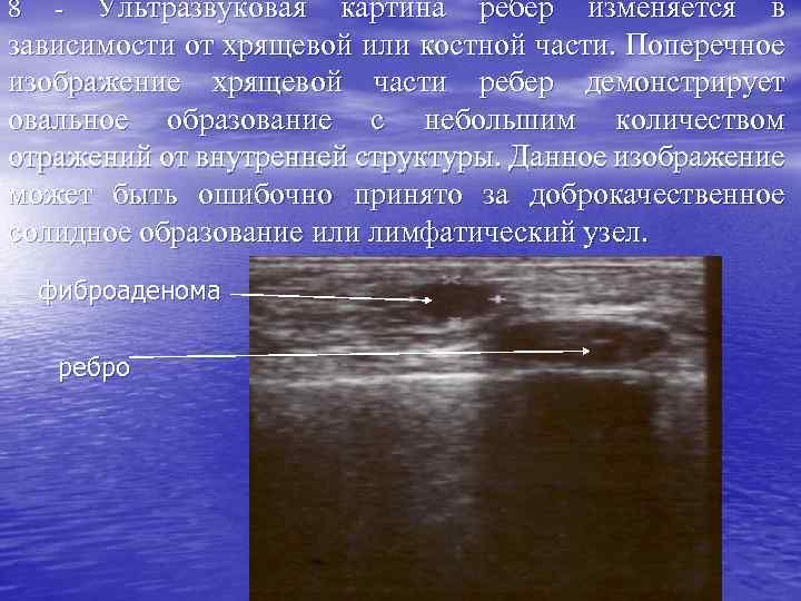 Ультразвуковая картина ребер изменяется в зависимости от хрящевой или костной части. Поперечное изображение хрящевой