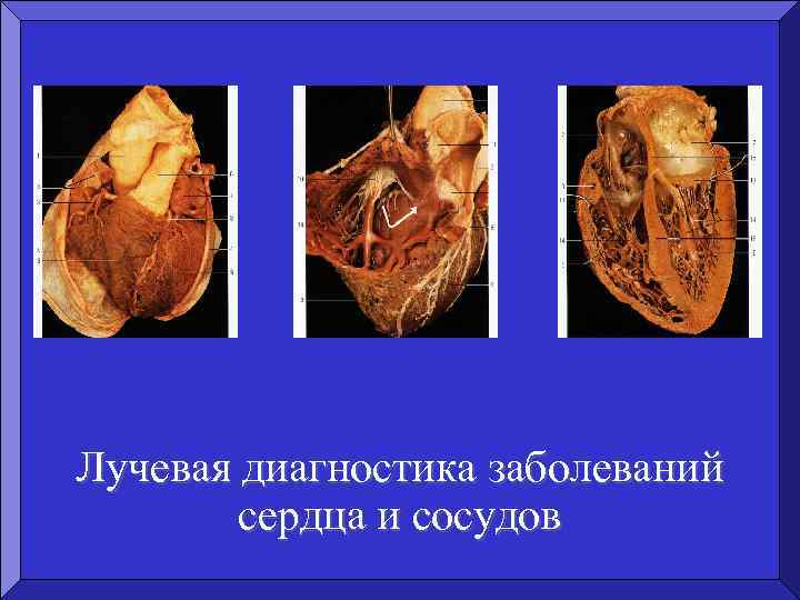 Лучевая диагностика заболеваний сердца и сосудов 