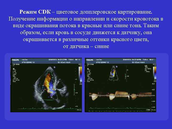 Режим CDК – цветовое допплеровское картирование. Получение информации о направлении и скорости кровотока в