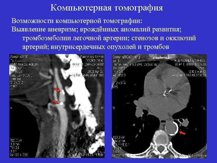 Компьютерная томография Возможности компьютерной томографии: Выявление аневризм; врождённых аномалий развития; тромбоэмболии легочной артерии; стенозов