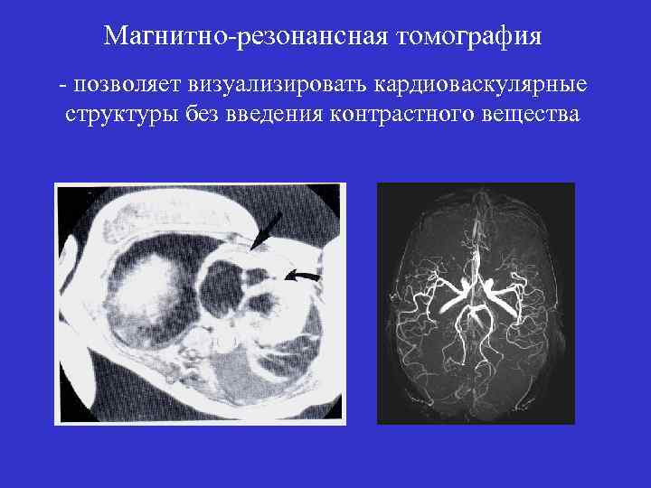 Магнитно-резонансная томография - позволяет визуализировать кардиоваскулярные структуры без введения контрастного вещества 