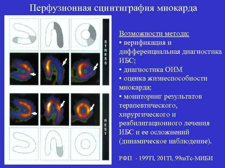 Перфузионная сцинтиграфия миокарда Возможности метода: • верификация и дифференциальная диагностика ИБС; • диагностика ОИМ