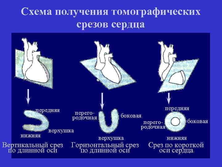 Схема получения томографических срезов сердца передняя нижняя перегородочная передняя боковая верхушка Вертикальный срез по