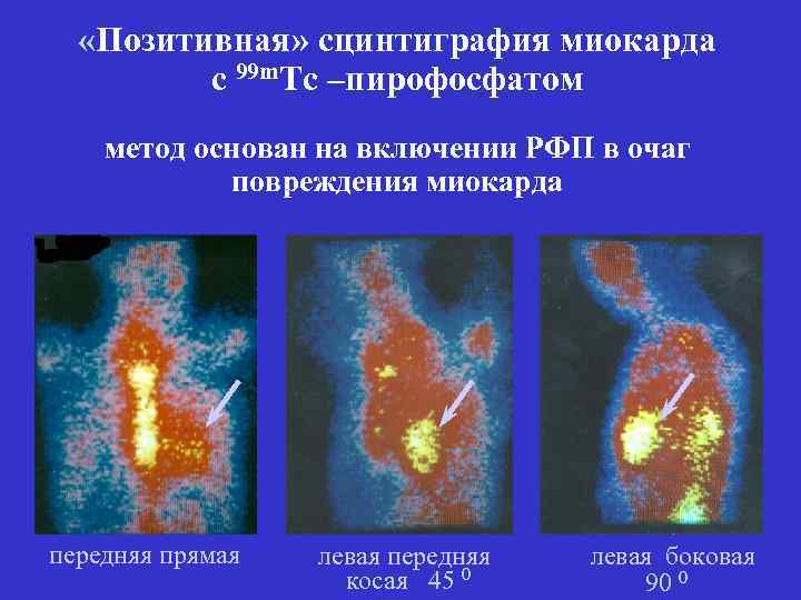  «Позитивная» сцинтиграфия миокарда с 99 m. Tc –пирофосфатом метод основан на включении РФП