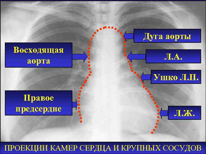Дуга аорты Восходящая аорта Л. А. Ушко Л. П. Правое предсердие Л. Ж. ПРОЕКЦИИ