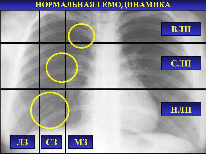 НОРМАЛЬНАЯ ГЕМОДИНАМИКА ВЛП СЛП НЛП ЛЗ СЗ МЗ 