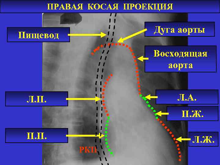 ПРАВАЯ КОСАЯ ПРОЕКЦИЯ Дуга аорты Пищевод Восходящая аорта Л. А. Л. П. Ж. П.
