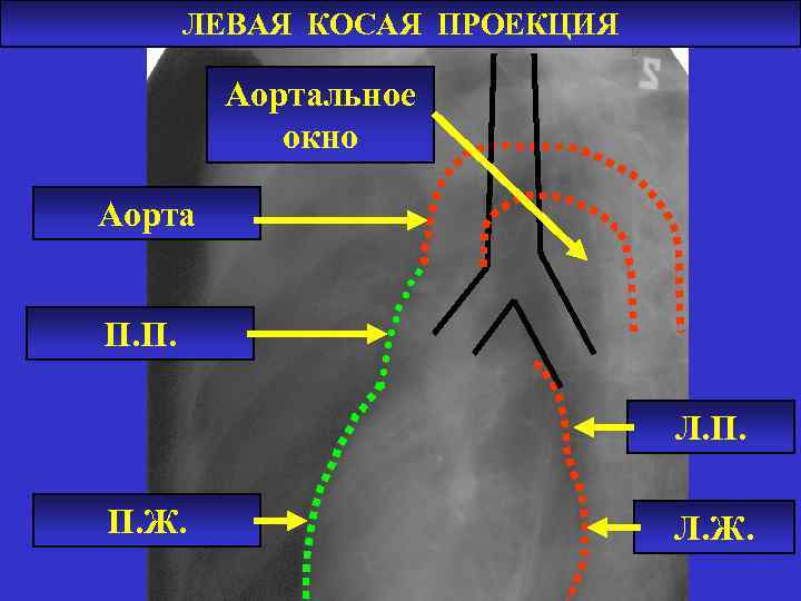 ЛЕВАЯ КОСАЯ ПРОЕКЦИЯ Аортальное окно Аорта П. П. Л. П. П. Ж. Л. Ж.