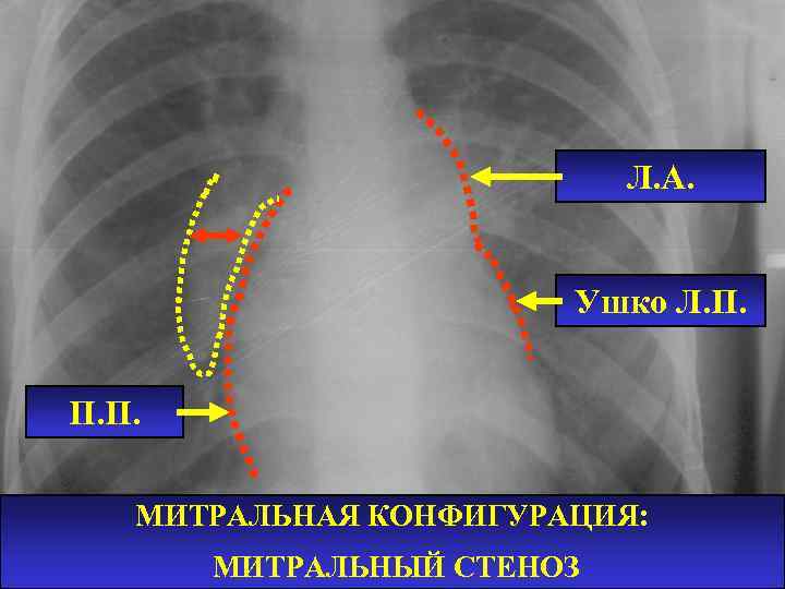 Л. А. Ушко Л. П. П. П. МИТРАЛЬНАЯ КОНФИГУРАЦИЯ: МИТРАЛЬНЫЙ СТЕНОЗ 