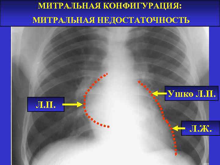 МИТРАЛЬНАЯ КОНФИГУРАЦИЯ: МИТРАЛЬНАЯ НЕДОСТАТОЧНОСТЬ Ушко Л. П. Л. Ж. 