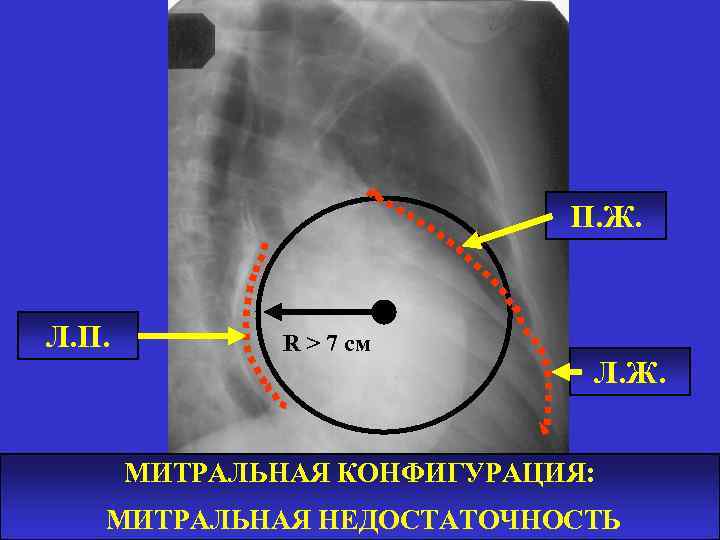 П. Ж. Л. П. R > 7 см Л. Ж. МИТРАЛЬНАЯ КОНФИГУРАЦИЯ: МИТРАЛЬНАЯ НЕДОСТАТОЧНОСТЬ