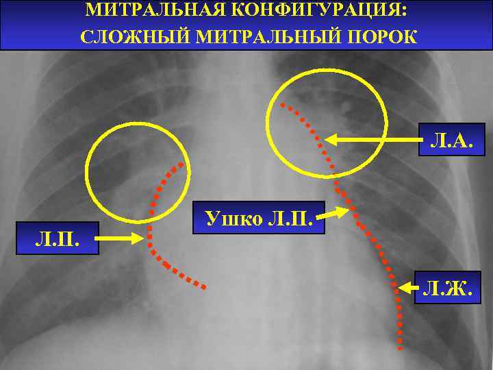 МИТРАЛЬНАЯ КОНФИГУРАЦИЯ: СЛОЖНЫЙ МИТРАЛЬНЫЙ ПОРОК Л. А. Л. П. Ушко Л. П. Л. Ж.