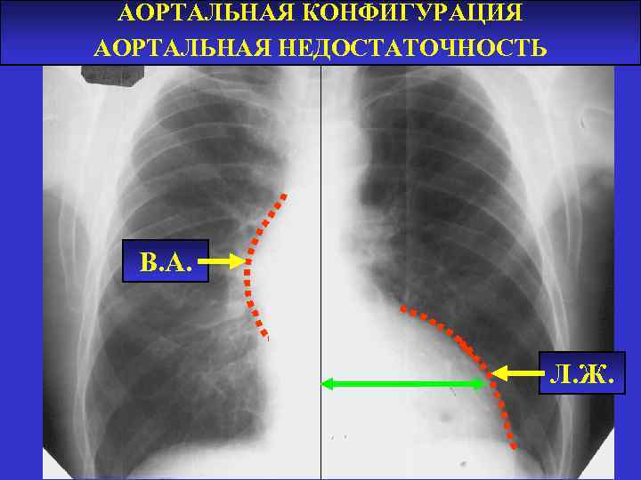 АОРТАЛЬНАЯ КОНФИГУРАЦИЯ АОРТАЛЬНАЯ НЕДОСТАТОЧНОСТЬ В. А. Л. Ж. 
