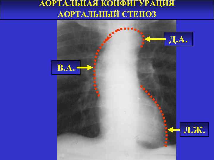 АОРТАЛЬНАЯ КОНФИГУРАЦИЯ АОРТАЛЬНЫЙ СТЕНОЗ Д. А. В. А. Л. Ж. 