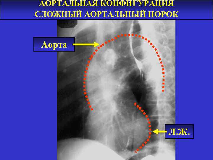 АОРТАЛЬНАЯ КОНФИГУРАЦИЯ СЛОЖНЫЙ АОРТАЛЬНЫЙ ПОРОК Аорта Л. Ж. 